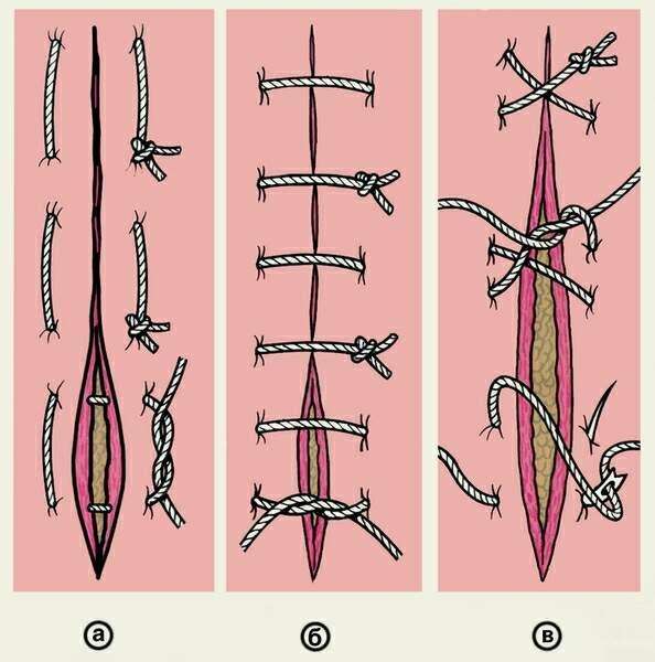 Швы хирургические