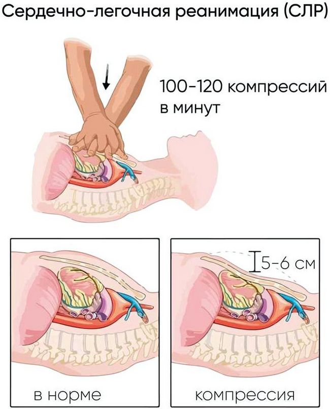 Сердечно-легочная реанимация.